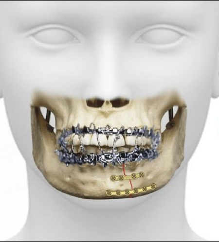 Jaw Fracture Treatment