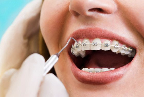 Orthodontic Treatment
