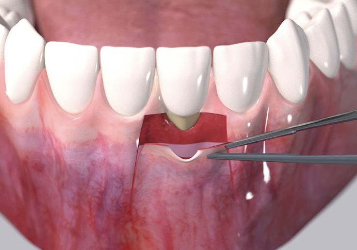 Periodontal Treatment